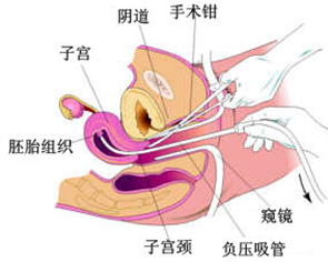 做完人流多久來(lái)月經(jīng)從什么時(shí)候算起,關(guān)于人流術(shù)后恢復(fù)月經(jīng)的相關(guān)數(shù)據(jù)解析,預(yù)測(cè)分析解釋定義_蘋果36.56.76