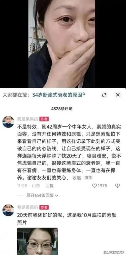 女生確診漸凍癥容貌巨變 母親回應